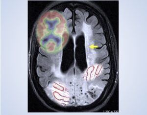 MRI 白質病變：血管還是阿茲海默？