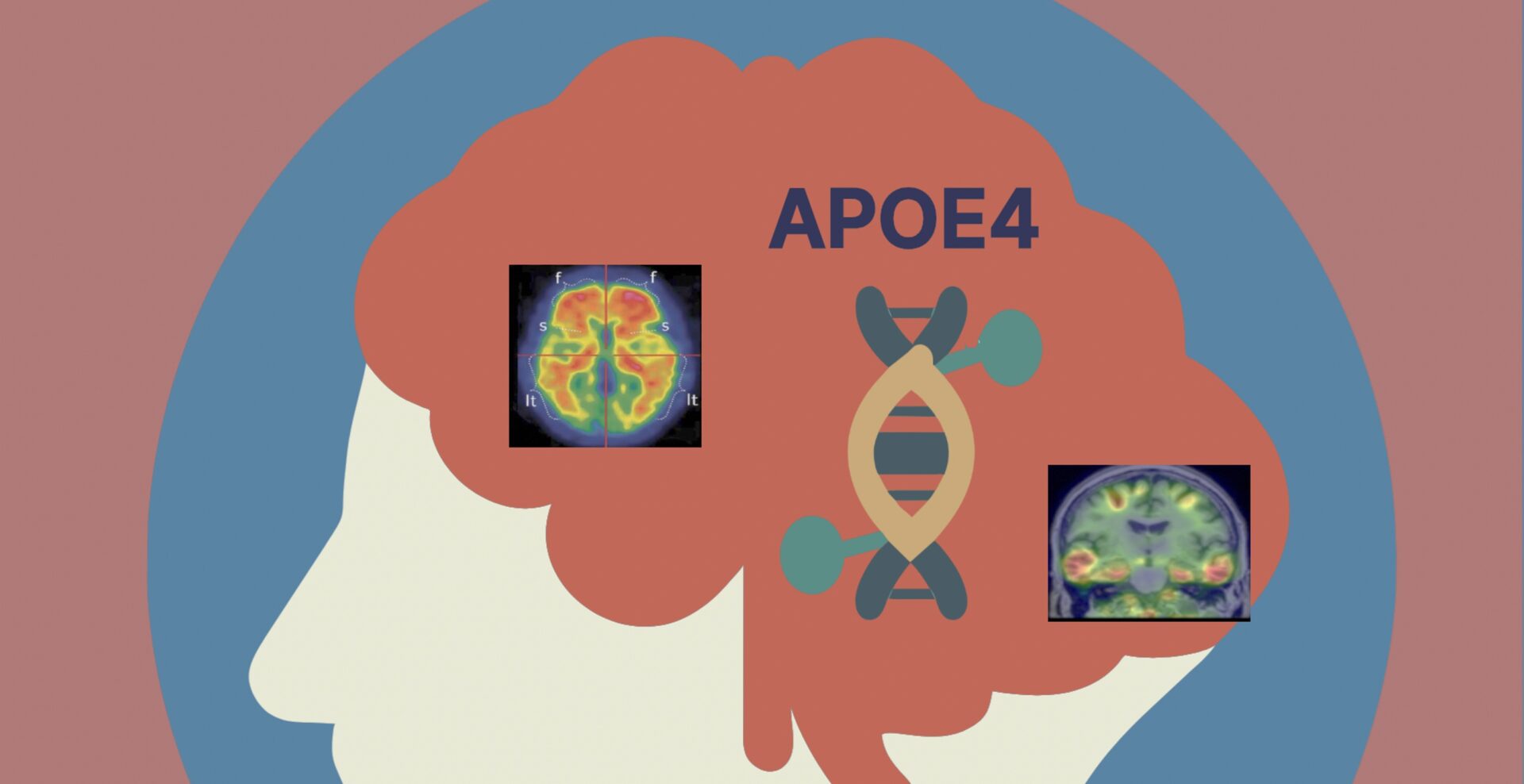ApoE4者要提早開始接受治療?ApoE4在極低的類澱粉沈積量時就開始加速tau蛋白的擴散速度