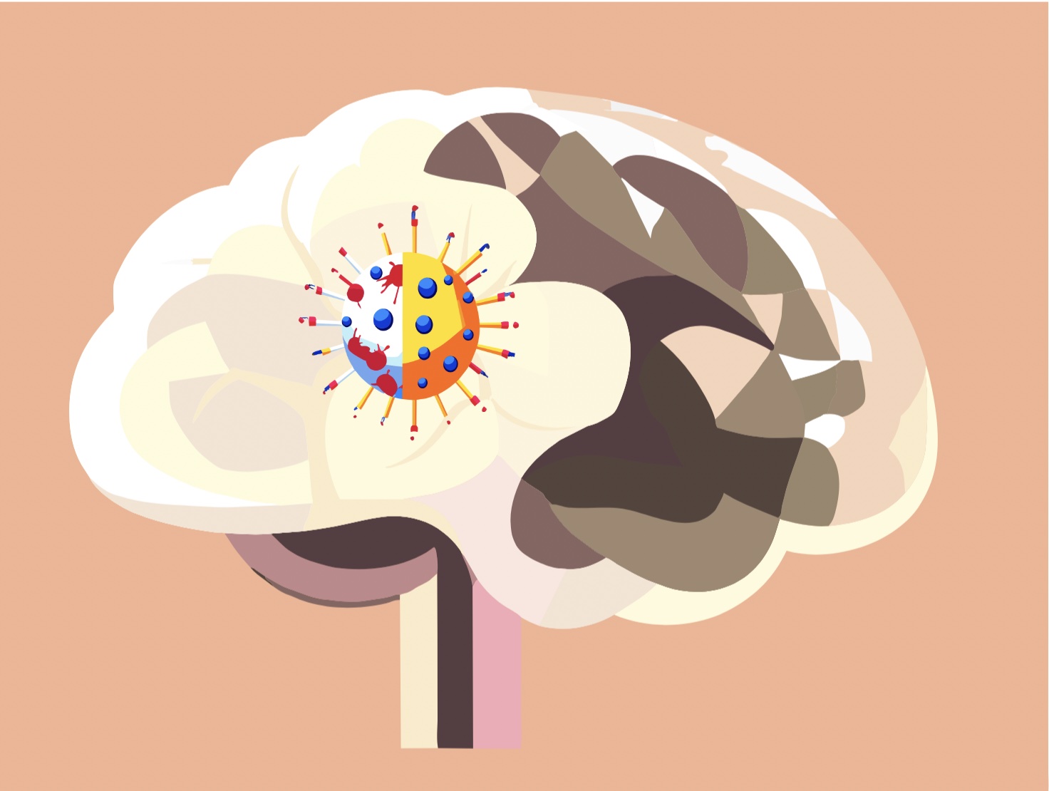 COVID-19造成持續性腦損傷? 血液生物標記顯示對腦神經長期的影響