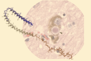 &alpha;Syn and lewy body