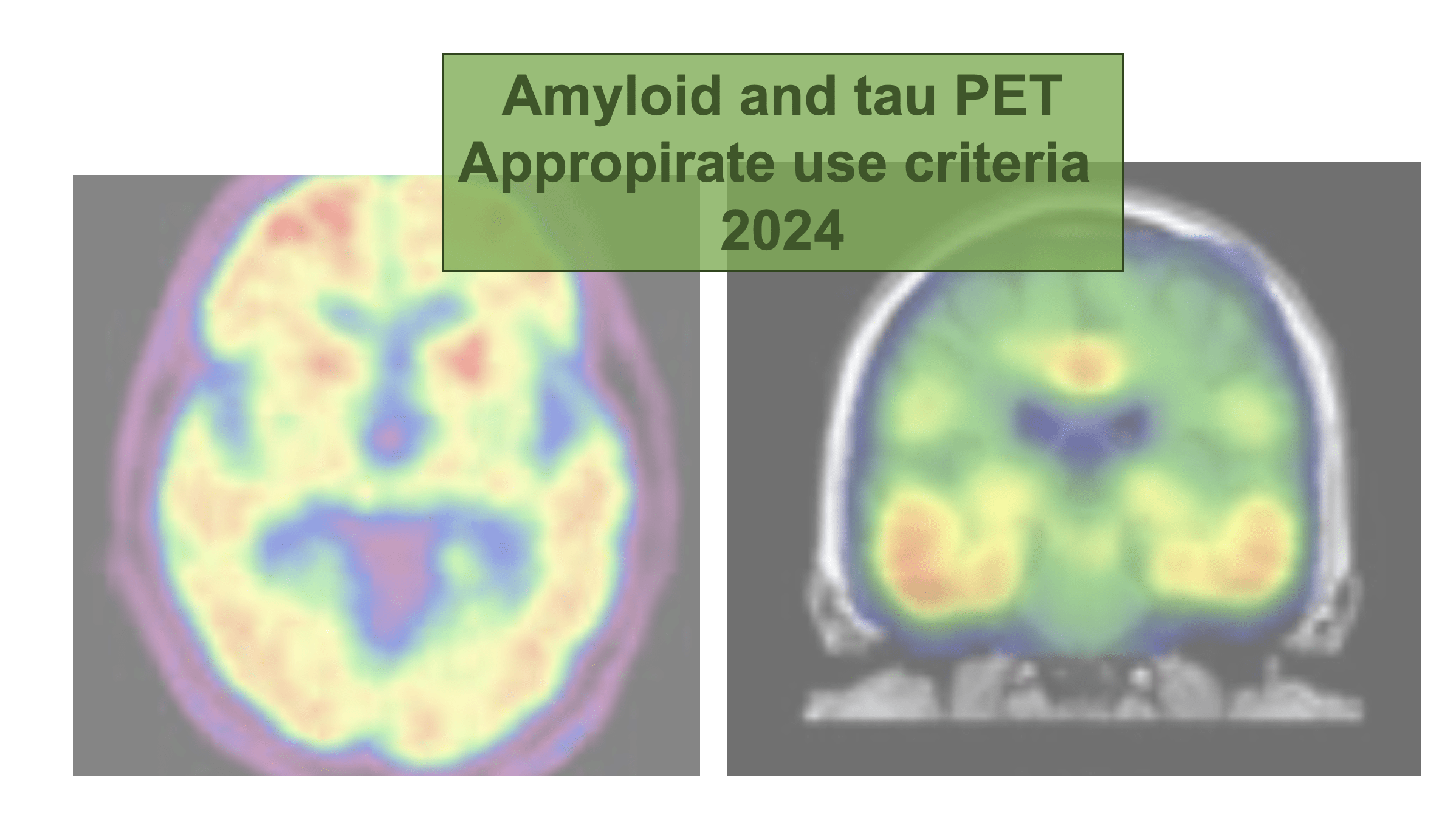 精準診斷阿茲海默症：2025 Amyloid 與 Tau 蛋白 PET 臨床應用指引