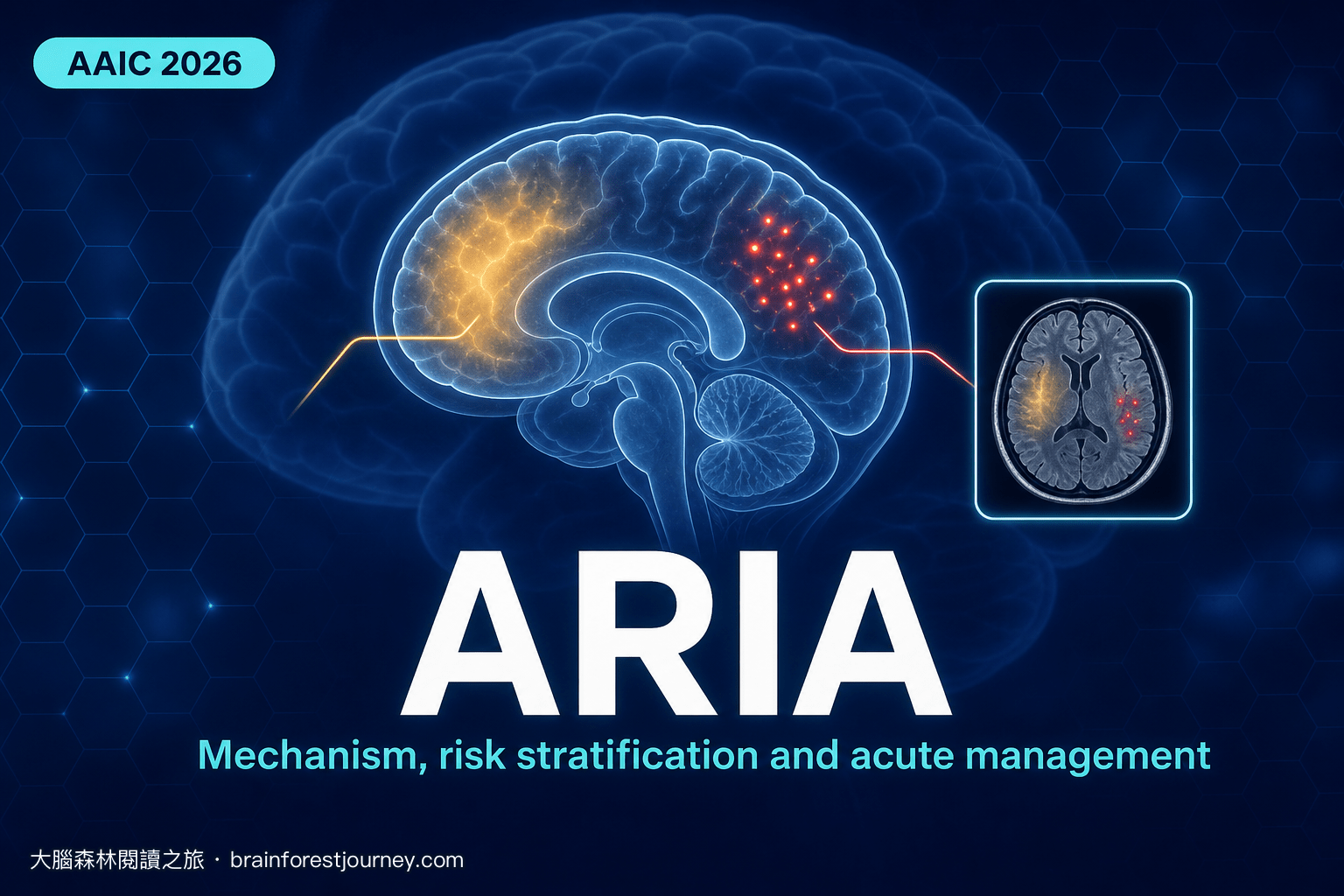 兩種 ARIA：ARIA-E 與 ARIA-H 的機轉、風險分層與急性期處置