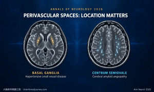 PERIVASCULAR SPACES: LOCATION MATTERS — basal ganglia (hypertensive small vessel disease) vs centrum semiovale (cerebral amyloid angiopathy), Annals of Neurology 2026